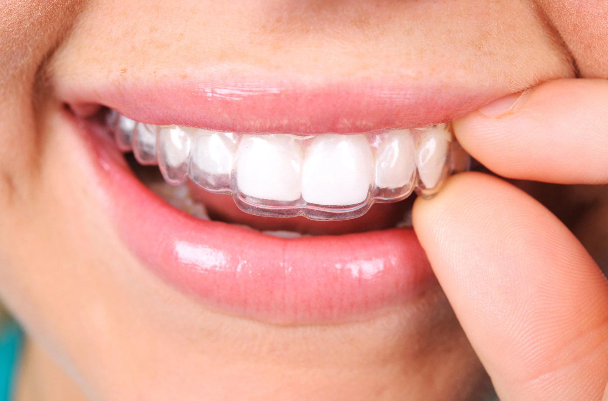 Everything you need to know about Invisalign: the invisible orthodontics  you just notice. - Puy - Dental Clinic (Barcelona)