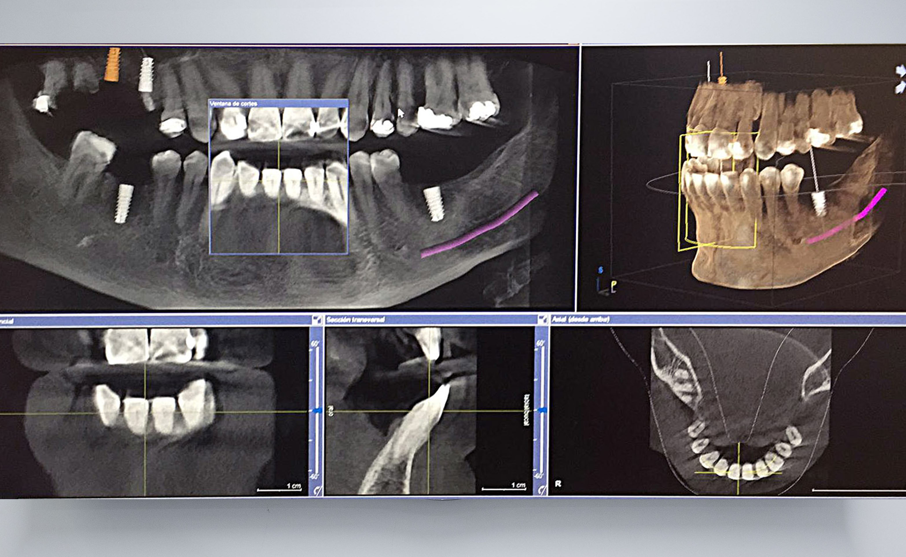 Imatge dels implants